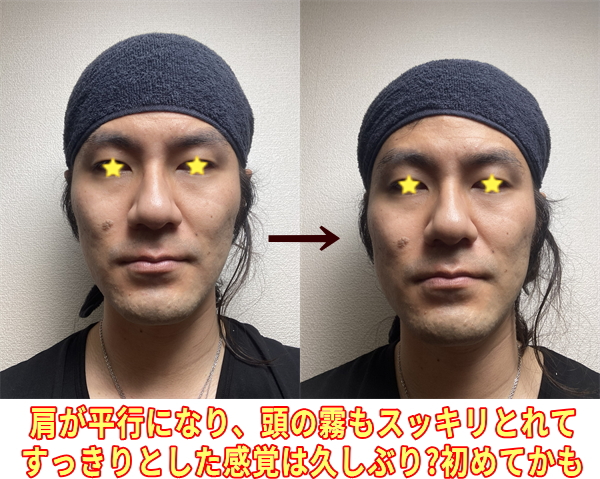 ビフォーアフター写真：肩が平行になり、頭の霧もスッキリとれて、すっきりとした感覚は本当に久しぶり、